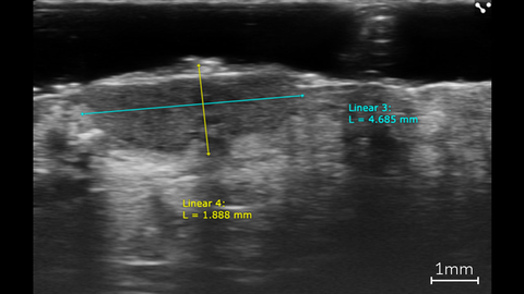 Linear measurements of a basal cell carcinoma in a patient using ultra high frequency ultrasound on the Vevo MD.