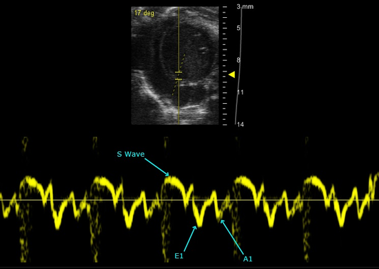 Tissue Doppler Mode at the mitral annulus and software analysis tools allow for various measurements to be preformed, here the early (E’), atrial (A’), and systolic (S) peak velocities are measured.